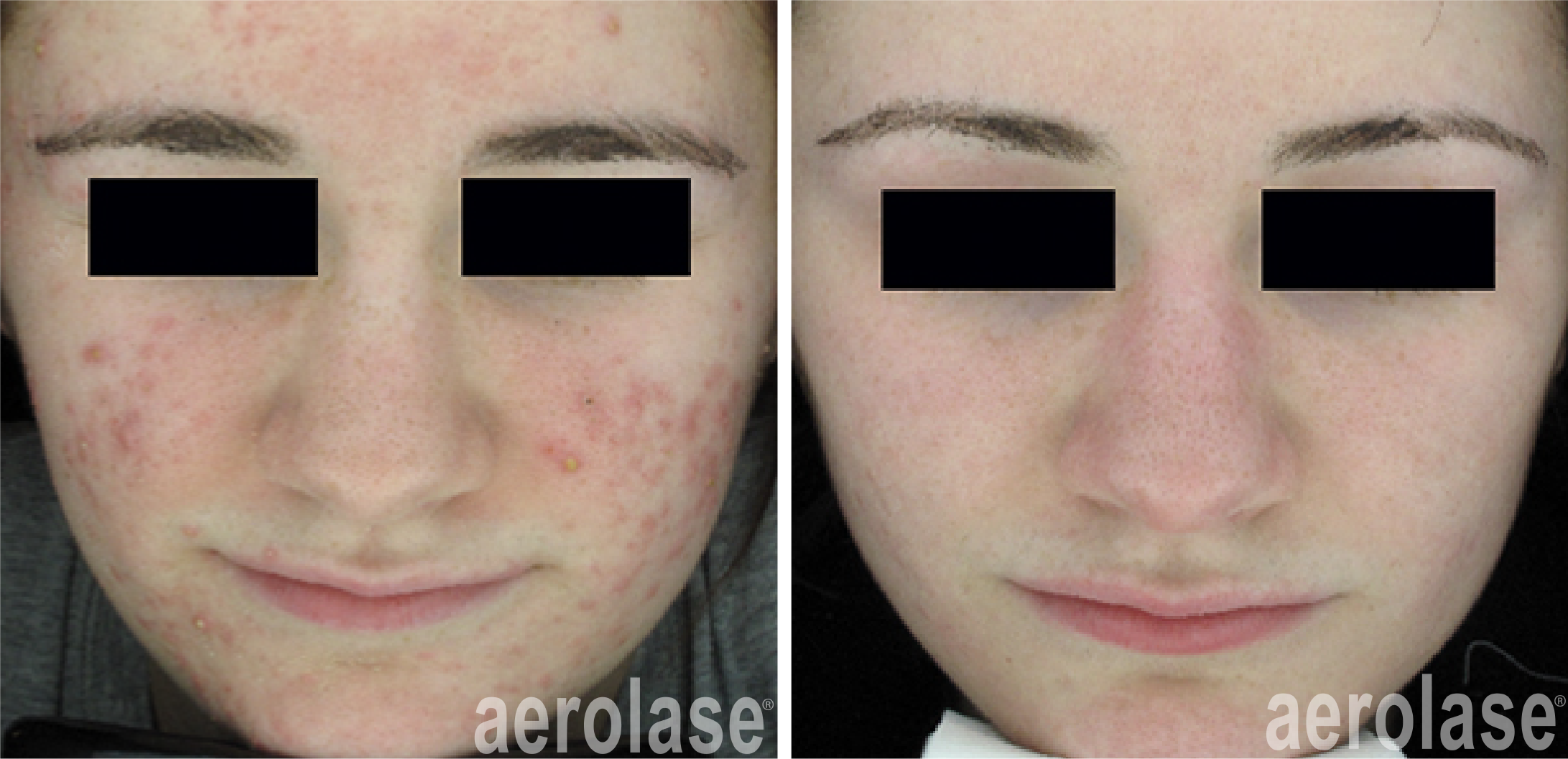 NeoClear Acne - 3 Months After 5 Treatments - David Goldberg MD