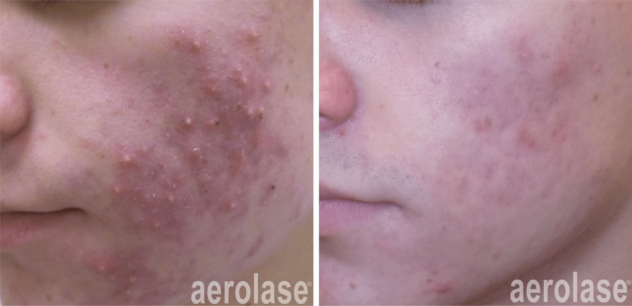 aerolase-kevin-pinski-before-after-acne-4-treatments