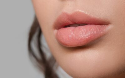 How Long Does It Take for Lip Fillers to Settle?