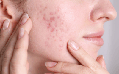 How To Get Rid of Acne Scars