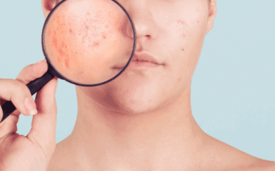 Are Laser Treatments an Effective Solution for Acne?