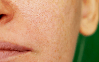 Pigmentation: Causes, Permanent Options, and Laser Treatments