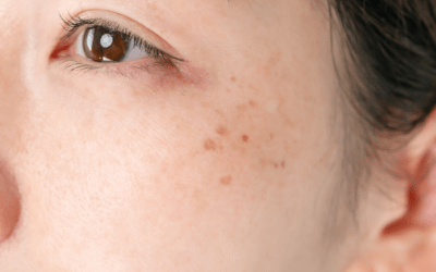 How Can I Get Rid of Liver Spots (lentigenes)? Causes, Removal, and Treatment Explained