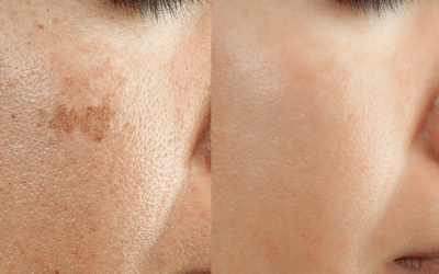 Getting Rid of Freckles: How Laser Treatment Works and What to Expect