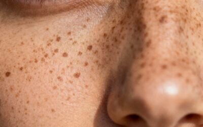 What Causes Freckles? Sun Exposure, Genetics, and Skin Cancer Myths